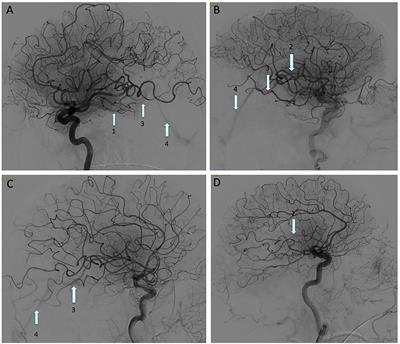 Early Venous Filling Following Thrombectomy: Association With Hemorrhagic Transformation and Functional Outcome